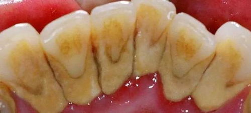 冲牙器有害论？破除2019年口腔卫生用品的误区