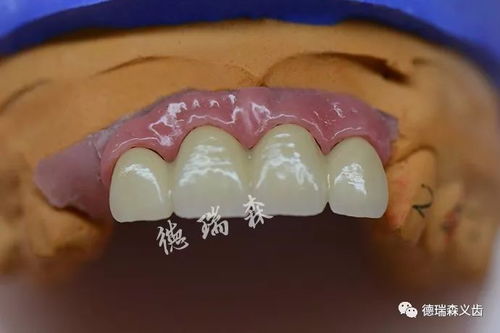 种植牙与口腔卫生用品 长期使用的关键